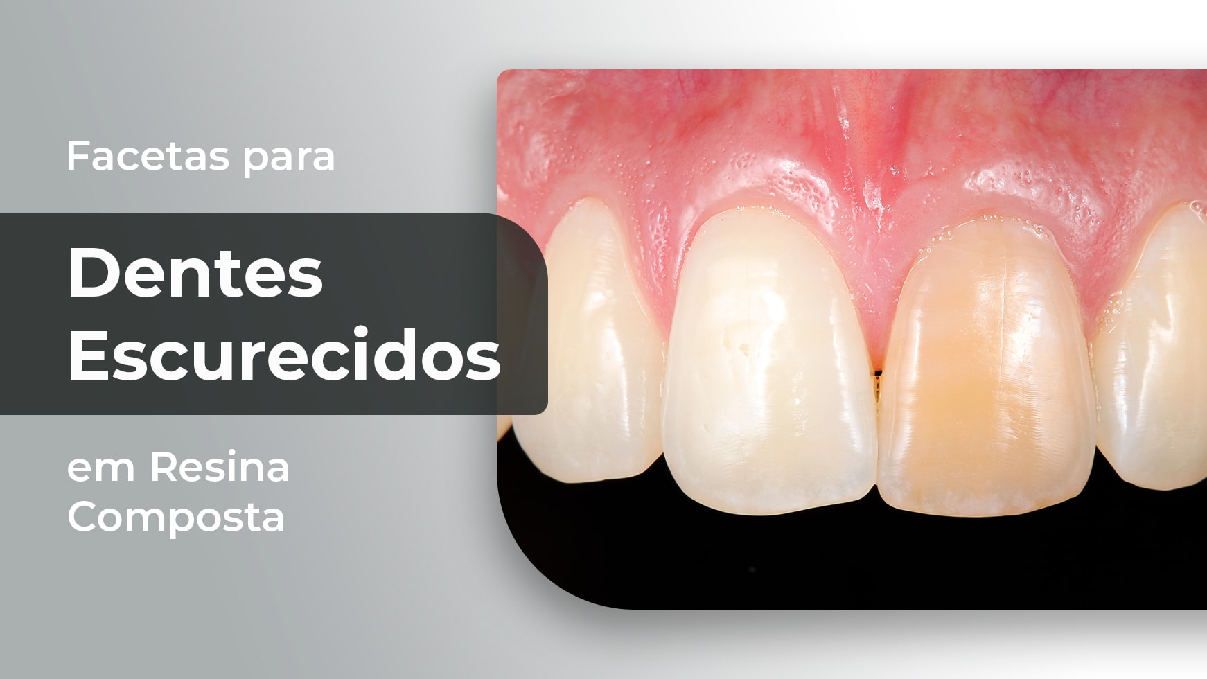Facetas para Dentes Escurecidos em Resina Composta