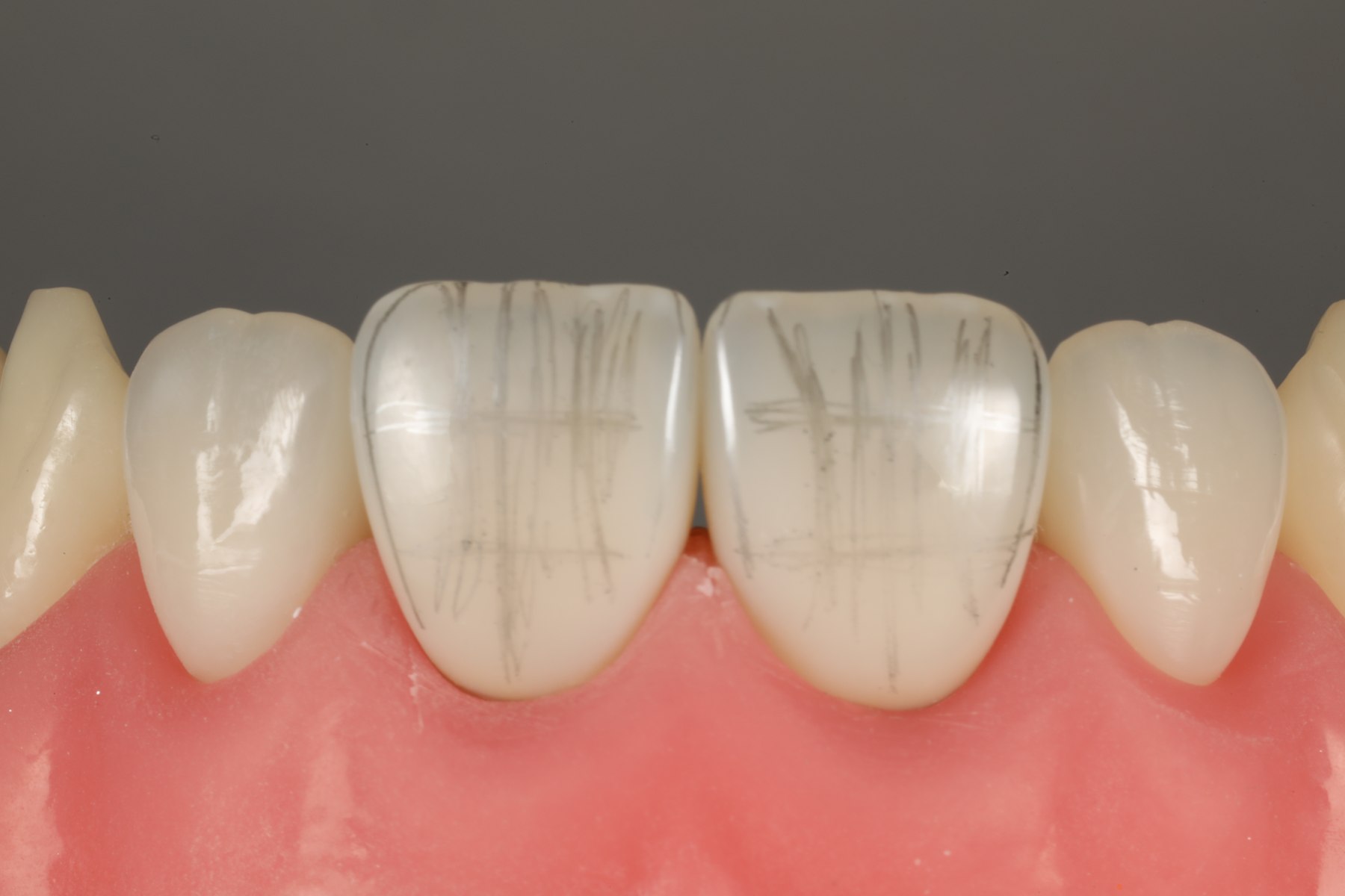 Anatomia das facetas em dentes escurecidos