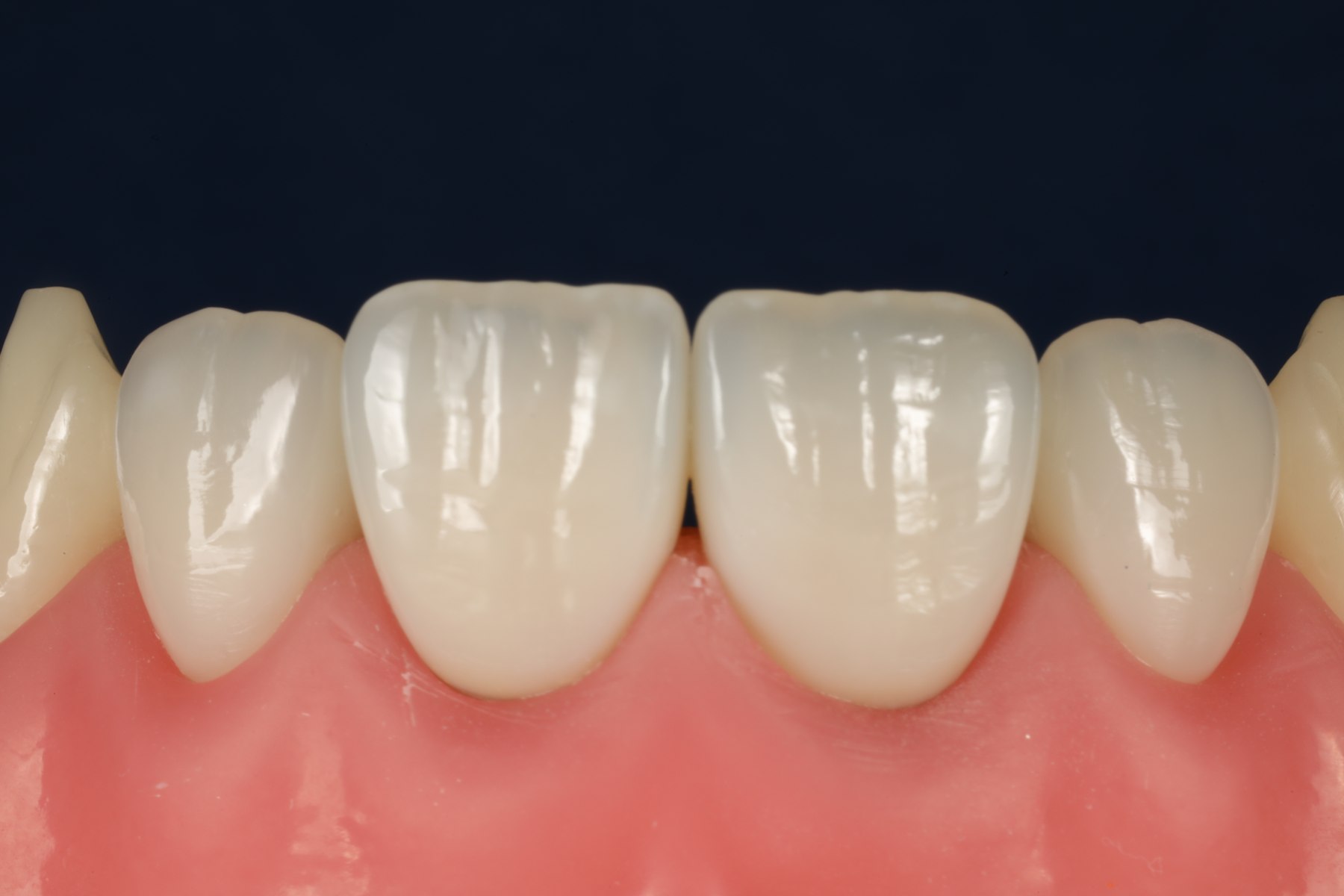 Acabamento e polimento de facetas em dentes escurecidos